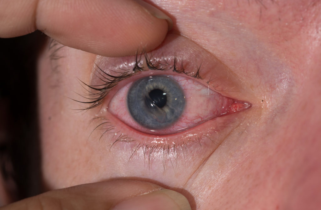 Woman with blue eyes having corneal scratch in her eye