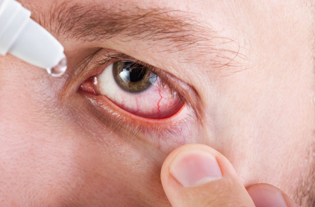Close-up of a human bloodshot eye and pouring dry eye drops in the eye.