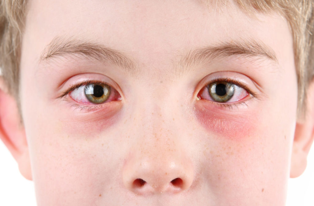 A close-up of a boy with pink eye