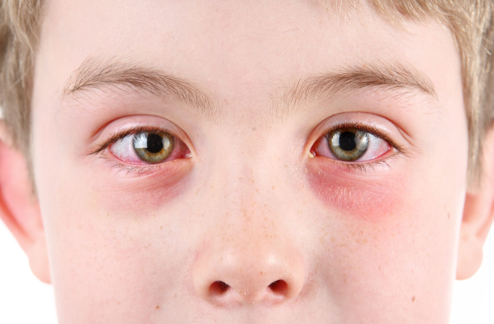 Stye on the Eyelid: Causes, Treatment, and More