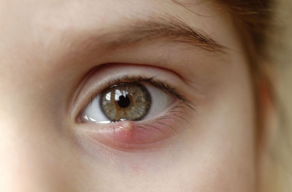 A close-up of an eye with lump that form on the edge of the eye lid